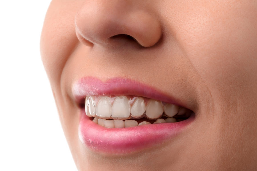 Como Funciona o Tratamento com Invisalign - VS Ortodontia